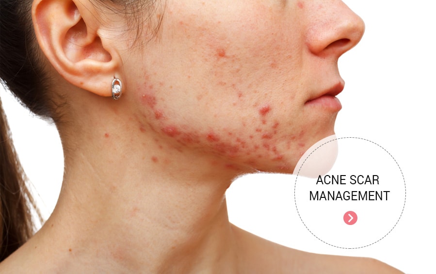 acne clinic in vijayawada